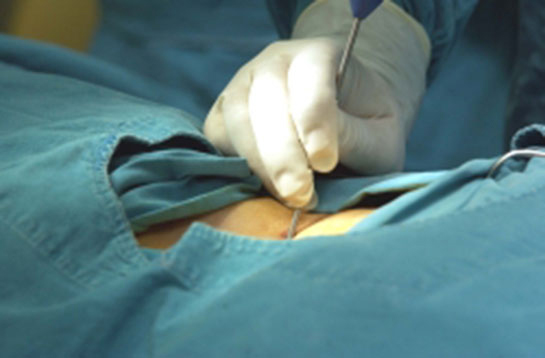 omurilik kaymasi ameliyati riskleri ve sonrasi